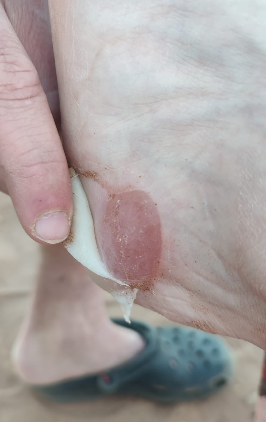 a big blister